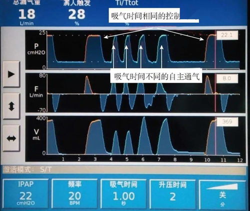 常見異常呼吸波形解讀