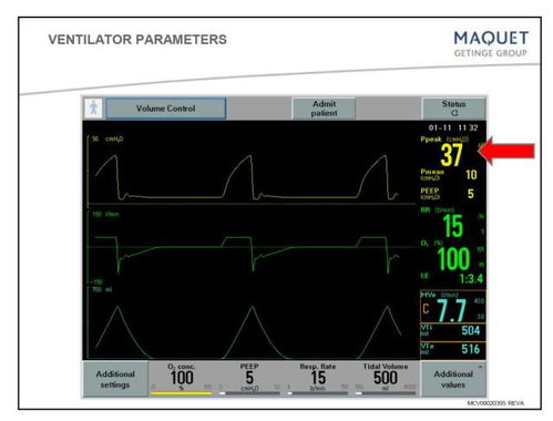 送給臨床小白 呼吸機(jī)模式及參數(shù)設(shè)置圖文詳解