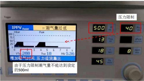 呼吸機(jī)5種模式不會(huì)選擇？看完這篇你就懂了——ST模式詳解